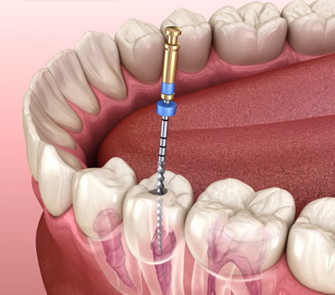 Root Canal Treatment