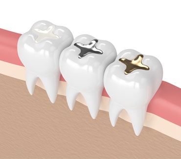 Dental Fillings
